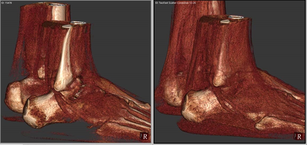 Image comparing results of Curvebeam's original technology (left) with those obtained using IBEX Trueview